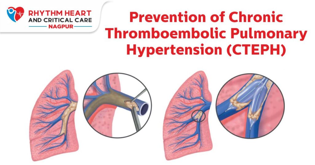 Rhythm Hospital - Pulmonary hypertension cannot be cured, but treatments can reduce your symptoms and help you manage your condition. If the cause is identified and treated early, it may be possible to prevent permanent damage to your pulmonary arteries, which are the blood vessels that supply your lungs. Not everyone is a candidate for pulmonary thromboendarterectomy (PEA) surgery. Your doctor may determine that PEA surgery is not right for you for reasons such as the blockages in your pulmonary arteries cannot be reached by the surgeon and are therefore inoperable. Your chronic thromboembolic pulmonary hypertension (CTEPH) team has decided, based on your overall health or other conditions, that the risk of surgery is too high. Even after PEA surgery, you may still experience some symptoms of CTEPH. Also, PEA surgery does not always cure CTEPH. Several studies found that CTEPH came back in approximately 1 out of 10 people who got the procedure. This is known as recurrent CTEPH. 1.4 Are any medical treatments available? As with so many diseases, medical science is always looking for new treatments. Speak to your doctor about the best options for you, and he or she may be able to keep you up-to-date with any new therapies that become available. What other treatments are available? As with many diseases, medical science is always looking for new treatments. One such treatment is the use of balloon pulmonary angioplasty, or BPA, to treat select patients with inoperable CTEPH. BPA uses a balloon catheter to make the arteries larger, allowing blood to flow through 5. PEA is the only potential cure for CTEPH, so it remains the gold standard for treatment. BPA has been performed for people who have CTEPH but can't have a PEA, and more research is needed on the long-term effects 5 Talk to your doctor about the best options for you. Chronic thromboembolic pulmonary hypertension (CTEPH) treatment includes Anticoagulants, which are commonly called blood thinners. Anticoagulants can help prevent clots from forming in the blood stream. CTEPH is potentially curable by a type of surgery called PEA, or Pulmonary thromboendarterectomy. If you've been diagnosed with CTEPH, your healthcare team will determine if PEA surgery is right for you. Although PEA is the recommended treatment for CTEPH, not everyone is a candidate. Even after PEA surgery, you can still experience CTEPH symptoms. As with so many diseases, medical science is always looking for new treatments, and oral medication has become available for a certain patient population. Speak to your doctor about the best options for you, and he or she may be able to keep you up-to-date with any new therapies that become available. Chronic thromboembolic pulmonary hypertension (CTEPH) is a complication of pulmonary embolism and a major cause of chronic PH leading to right heart failure and death. Lung ventilation/perfusion scintigraphy is the screening test of choice; a normal scan rules out CTEPH.